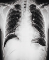 Image of perforated bowel